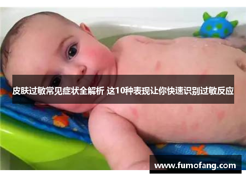 皮肤过敏常见症状全解析 这10种表现让你快速识别过敏反应